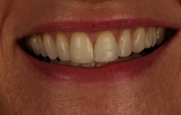 Smile Gallery - Church Road Dental and Cosmetic
