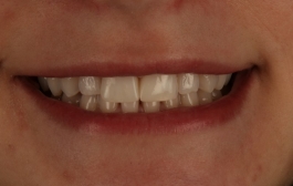 Smile Gallery - Church Road Dental and Cosmetic