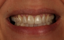 Smile Gallery - Church Road Dental and Cosmetic