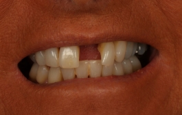 Smile Gallery - Church Road Dental and Cosmetic