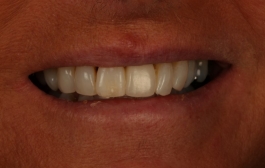 Smile Gallery - Church Road Dental and Cosmetic