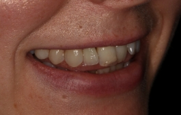 Smile Gallery - Church Road Dental and Cosmetic