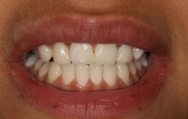 Smile Gallery - Church Road Dental and Cosmetic