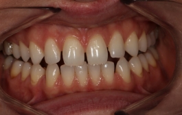 Smile Gallery - Church Road Dental and Cosmetic