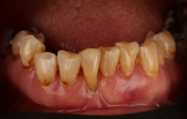 Smile Gallery - Church Road Dental and Cosmetic