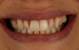 Smile Gallery - Church Road Dental and Cosmetic