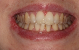 Smile Gallery - Church Road Dental and Cosmetic