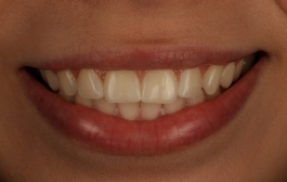 Smile Gallery - Church Road Dental and Cosmetic
