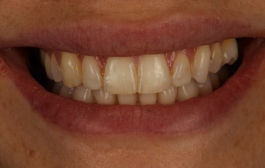 Smile Gallery - Church Road Dental and Cosmetic