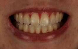 Smile Gallery - Church Road Dental and Cosmetic