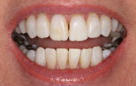 Smile Gallery - Church Road Dental and Cosmetic