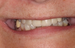 Smile Gallery - Church Road Dental and Cosmetic