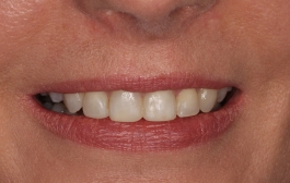 Smile Gallery - Church Road Dental and Cosmetic