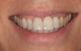 Smile Gallery - Church Road Dental and Cosmetic