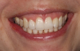 Smile Gallery - Church Road Dental and Cosmetic
