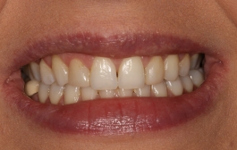 Smile Gallery - Church Road Dental and Cosmetic