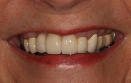 Smile Gallery - Church Road Dental and Cosmetic