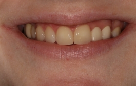 Smile Gallery - Church Road Dental and Cosmetic