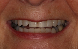 Smile Gallery - Church Road Dental and Cosmetic