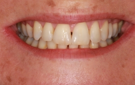 Smile Gallery - Church Road Dental and Cosmetic