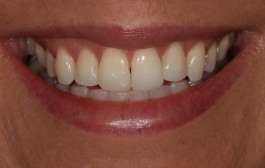 Smile Gallery - Church Road Dental and Cosmetic