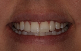 Smile Gallery - Church Road Dental and Cosmetic