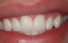 Smile Gallery - Church Road Dental and Cosmetic