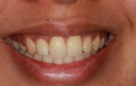Smile Gallery - Church Road Dental and Cosmetic