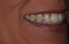 Smile Gallery - Church Road Dental and Cosmetic