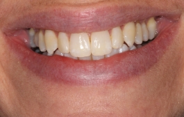 Smile Gallery - Church Road Dental and Cosmetic