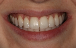 Smile Gallery - Church Road Dental and Cosmetic