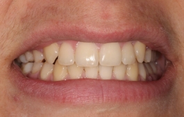 Smile Gallery - Church Road Dental and Cosmetic