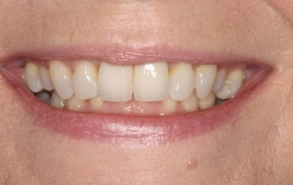 Smile Gallery - Church Road Dental and Cosmetic