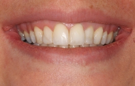 Smile Gallery - Church Road Dental and Cosmetic