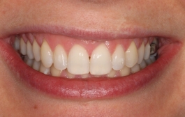 Smile Gallery - Church Road Dental and Cosmetic