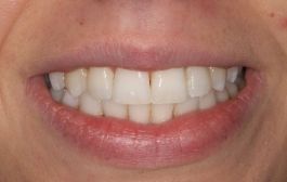 Smile Gallery - Church Road Dental and Cosmetic