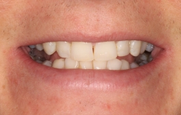 Smile Gallery - Church Road Dental and Cosmetic