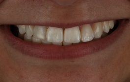 Smile Gallery - Church Road Dental and Cosmetic