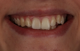 Smile Gallery - Church Road Dental and Cosmetic