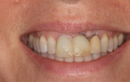 Smile Gallery - Church Road Dental and Cosmetic