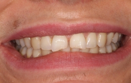 Smile Gallery - Church Road Dental and Cosmetic