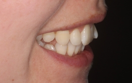 Smile Gallery - Church Road Dental and Cosmetic