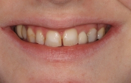 Smile Gallery - Church Road Dental and Cosmetic