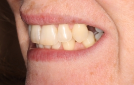 Smile Gallery - Church Road Dental and Cosmetic