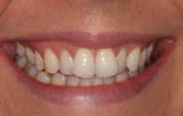 Smile Gallery - Church Road Dental and Cosmetic