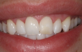 Smile Gallery - Church Road Dental and Cosmetic