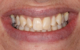 Smile Gallery - Church Road Dental and Cosmetic