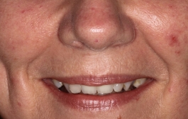 Smile Gallery - Church Road Dental and Cosmetic