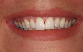 Smile Gallery - Church Road Dental and Cosmetic