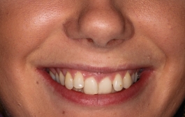 Smile Gallery - Church Road Dental and Cosmetic